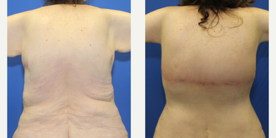 55-64 year old woman treated with Back Lift - This is a 62 year old White female patient who is 510 and weighed 375 pounds.  She had duodenal switch surgery and lost 165 pounds.  After weight loss, she had excess skin and fat in her back area.  She underwent a horizontal torsoplasty with Dr. J. Timothy Katzen in Beverly Hills, CA.  Dr. Katzen removed 3 pounds of excess fat and skin from her back.  Notice how much better her back looks now.  She is very happy with her results.
