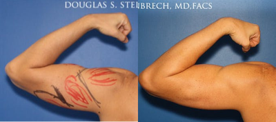 Man treated with Bicep Implants - Man treated with Bicep Implants