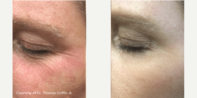 Woman treated with PlasmaPen - Woman treated with PlasmaPen