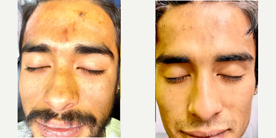 Man treated with Scar Removal, Laser Scar Removal - Man treated with Scar Removal, Laser Scar Removal
