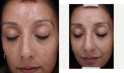 35-44 year old woman treated with Skin Rejuvenation - LaseMD is so new, it's not even a category on Realself yet! We just started offering LaseMD and clearly, the results are amazing. It's great for anti-aging, age spots, sun spots, melasma, freckles, pigment reduction, actinic keratosis, mild to moderate sun damage, and even decollete care! Visit us for a Free Consultation to learn more about this new, non-ablative laser treatment!