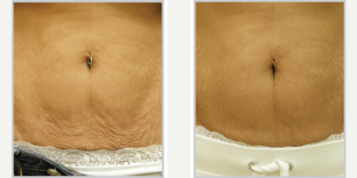 35-44 year old woman treated with Skintyte - Skintyte