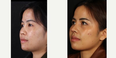 25-34 year old woman treated with Rhinoplasty, Asian Rhinoplasty - 3 weeks after rhinoplasty with rib graft for our beautiful patient! She is recovering so well and we could not wait any longer to get her photos out there. We borrowed her rib and deeper soft tissue to create a bridge with an onlay graft and project her tip with the extra cartilage. We still have more swelling we expect to resolve with more time, especially above her tip and we can't wait for it to continue to narrow. Thanks to her for allowing us to share!