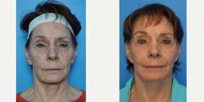 65-74 year old woman treated with Facelift Revision - Revision secondary facelift with laser resurfacing