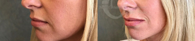 25-34 year old woman treated with Lip Augmentation - 25-34 year old woman treated with Lip Augmentation