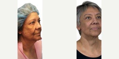 65-74 year old woman treated with Lip Lift, Lip Surgery, Lip Repositioning - Lip lift performed in combination with deep plane facelift and neck lift surgery to restore facial harmony and create elegant, natural rejuvenation. Notice the improvement in facial balance, horizontal thirds, upper tooth show, and the meticulously concealed lip lift scar.