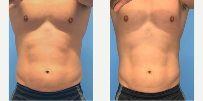 36 year old man treated with CoolTone - 36 year old male underwent a total of 4 CoolTone cycles (in a 2 week span) in the abdomen area.