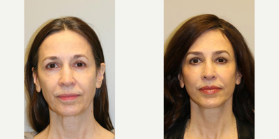Woman treated with Brow Lift - Woman treated with Brow Lift