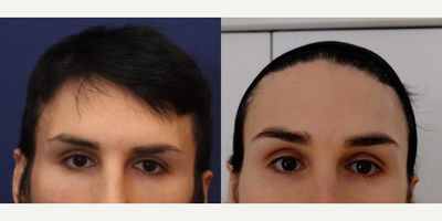 Transgender woman treated with Forehead Reduction - Transgender woman treated with Forehead Reduction