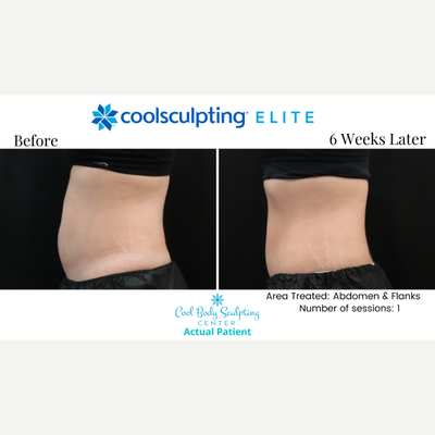 45-54 year old woman treated with CoolSculpting Elite - CoolSculpting before and after in Virginia Beach