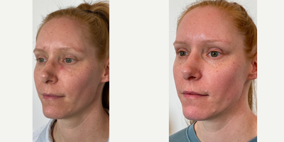 25-34 year old woman treated with Opus Plasma - This client had a series of 3 Opus Plasma treatments to help treat her concerns of tone, texture and the signs of aging. She continues to use medical grade skin care.