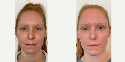 25-34 year old woman treated with Opus Plasma - This client had a series of 3 Opus Plasma treatments to help treat her concerns of tone, texture and the signs of aging. She continues to use medical grade skin care.
