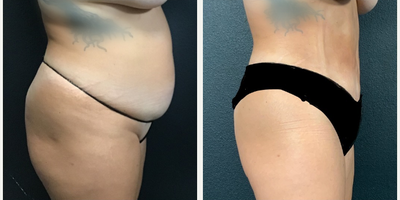 Woman treated with Vaser Liposuction, Renuvion - Woman treated with Vaser Liposuction, Renuvion