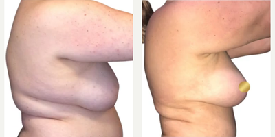 Woman treated with Breast Lift, Breast Fat Transfer - Woman treated with Breast Lift, Breast Fat Transfer