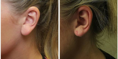 Woman treated with Earlobe Surgery - Woman treated with Earlobe Surgery