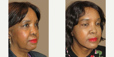 Woman treated with Brow Lift - Woman treated with Brow Lift