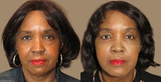 Woman treated with Brow Lift - Woman treated with Brow Lift