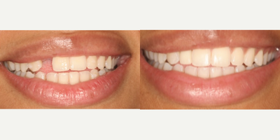 Patient treated with Dental Implants, Smile Makeover - What a beautiful implant transformation! Can you believe how natural it looks