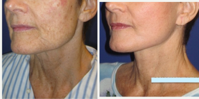 55-64 year old woman treated with a Face Lift, Neck Lift, and Full Face CO2 Fractional Laser Skin Resurfacing - This patient came to me full of energy. She is very active and lives a healthy lifestyle, however she felt like her appearance did not represent how she felt on the inside. After taking time to understand her goals and her aging pattern, I recommended a lower facelift, neck lift, and full face CO2 fractional laser skin resurfacing to recapture a more youthful appearance that complimented how she felt on the inside. One of my many goals is to achieve a natural looking result without any of the tell-tale signs of surgery. Her pictures are a little over 3 months after her procedure. Her recovery time was about 7 days.
