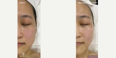 25-34 year old woman treated with HydraFacial - Mid 20s woman treated with HydraFacial