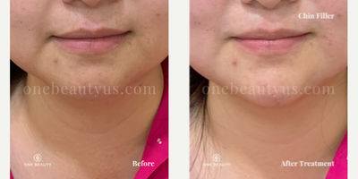 35-44 year old woman treated with Chin Filler, Juvederm - mid 20s year old treated with Juvderm for Chin Augmentation