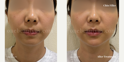 25-34 year old woman treated with Voluma, Chin Filler, Juvederm - Mid 20s year old treated with Juvderm for Chin Augmentation