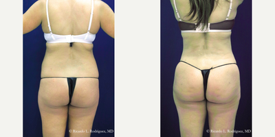 35-44 year old woman treated with Brazilian Butt Lift - Total amount of fat removed: 4500 ccTotal amount of fat injected: 1200 cc