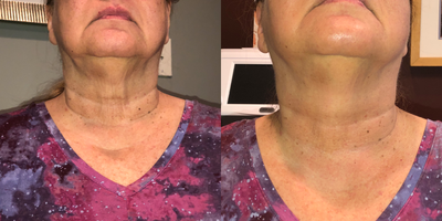 Woman treated with TempSure - Woman treated with TempSure. Results are after 1 treatment.