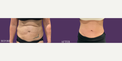 Woman treated with Tummy Tuck - Woman treated with Extended Tummy Tuck and Liposuction to back and flanks for a more toned, smooth, and contoured look through removal of abdominal laxity. Pre-op, patient was dissatisfied with the appearance of her abdomen.