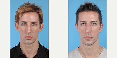 34 year old man treated with Ear Surgery - A 34 year-old Gentleman before and after Rhinoplasty and Correction of Prominent Ears ( Otoplasty) by Andrew Lyos M.D FACS.