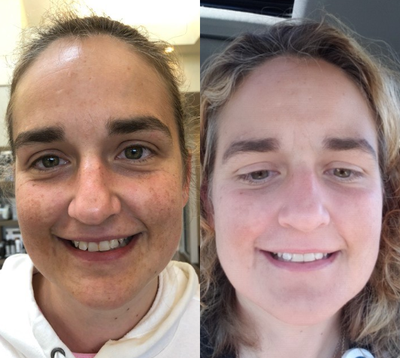 35-44 year old woman treated with SkinMedica - Restore your skin to it's most beautiful shade of even. Groundbreaking technology is clinically shown to significantly improve the appearance of even the most stubborn skin discoloration and overall photo-damage in as early as 4 weeks. Proven to work across all skin tones and types.