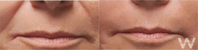 Woman treated with Radiesse - Woman treated with Radiesse