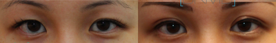 Correction of suture double eyelid surgery with incisional method - This woman had a previous suture method double eyelid surgery. Her right crease was lost after 5 years. Dr. Kotlus performed the incisional method on both eyes to achieve more defined creases.