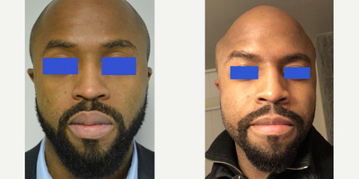 25-34 year old man treated with Lip Reduction - A man in his late 20s who is bothered by prominence of his lips He is shown before and again, 10 months after a bikini lip reduction of the upper and lower lips. His after photo has a different perspective and angle as it was kindly provided by the patient who has since moved across the country.