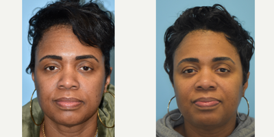 45-54 year old woman treated with Chemical Peel, Neo Laser, Laser Resurfacing - This patient received Aerolase, hydrafacials, botox, and LHR.