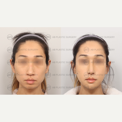 18-24 year old woman treated with Jaw Reduction, Cheekbone Reduction, Genioplasty, Rhinoplasty - By: Dr. Kim Joo Yeon, Dr. Ahn Seung Hyun