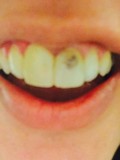 My Composite Having Black Spot On Front Tooth 1 Week After Procedure