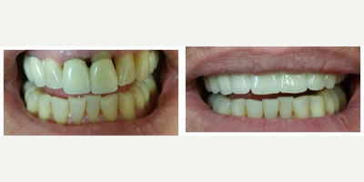 65-74 year old man treated with Anterior Bridge after extraction - Anterior Bridge after extraction of #8 and 9