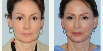 Woman treated with Mini Facelift - Before and 3 weeks after mini-facelift with submental liposuction.