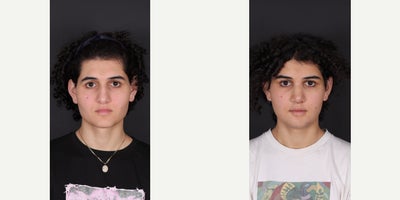 18-24 year old man treated with Facial Feminization Surgery - Frontoplasy Type 3 (Frontal Sinus Set Back)+ Brow Bone Shaving + Jaw Reduction + Chin Reduction +Feminizing Rhinoplasty