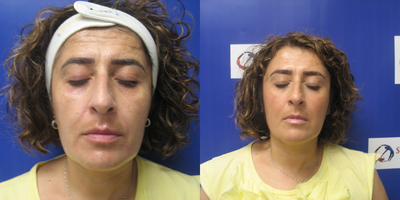 45-54 year old woman treated with Sylfirm X - Patient with hyperpigmentation and melasma, before and after 3 Sylfirm X microneedling treatments. After photo 1 month post procedure.