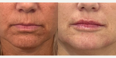 Woman treated with Lip Fillers - Woman treated with Lip Fillers