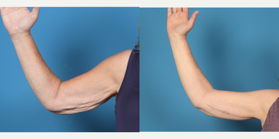 55-64 year old woman treated with Arm Lift - BILATERAL ARM BRACHIOPLASTY WITH LIPOSUCTION LATERAL DISTAL ARMS (N/C)