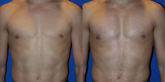 Pec Implants - 34 year old male 3 weeks after pectoral implants using soft, solid vertical-rectangular implants placed under the muscle. He requested a conservative, natural appearing and undetectable result which was completely accomplished. He will develop a substantially more defined and sculpted appearance as the swelling subsides and healing progresses.