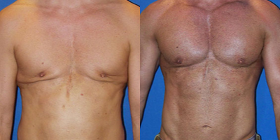 Pec Implants - This is a 46 year old male is now 4 years after correction of deformity from gynecomastia surgery using soft, solid vertical-rectangular pec implants placed under the muscle, liposculpture, scar tissue release, dermal graft and fat grafting. The midline sternal scar was from surgery many years prior.