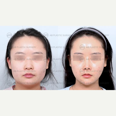 25-34 year old woman treated with Cheekbone Reduction, Genioplasty, Jaw Reduction, Asian Rhinoplasty, Facial Fat Transfer - By: Dr. Ahn Seung Hyun, Dr. Bae In Ho, Dr. Kim Joo Yeon