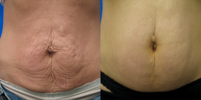 35-44 year old woman treated with Skin Tightening - Titan treatments (3) for abdominal tightening