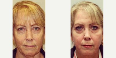Woman treated with Nonsurgical Neck Lift - Woman treated with Nonsurgical Neck Lift through FaceTite for improvement of neck contour and jowls as well as Laser Resurfacing using erbium laser to even out skin tone and smooth out fine lines