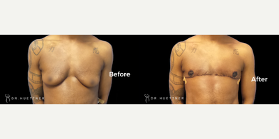 Woman treated with FTM Chest Masculinization Surgery - Woman treated with FTM Chest Masculinization Surgery