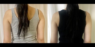 25-34 year old woman treated with Lipodissolve - Fat-dissolving injections to refine the upper arm line